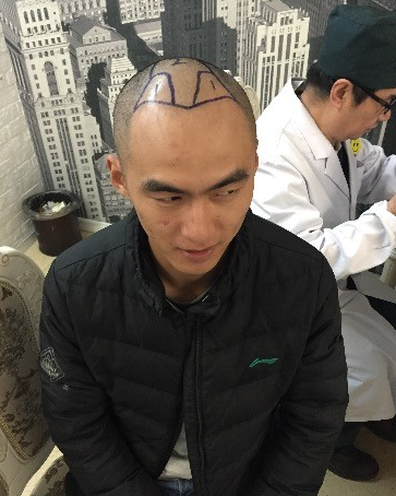 给我带来了一种返老还童的感觉，上海大麦微针真心不错