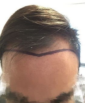 上海大麦微针植发3200单位，打开我的重生之门