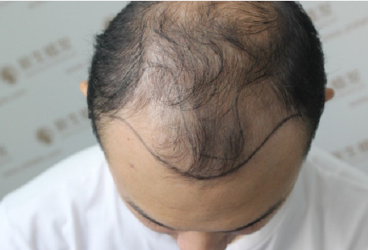 在南京新生植发的前前后后像变了个人一样，天差地别