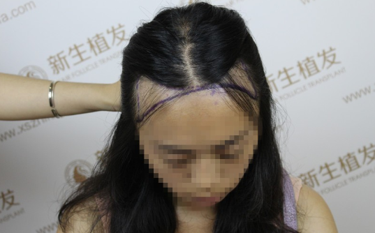 一个小小的发际线却让我有了大大的改变,感恩南京新生