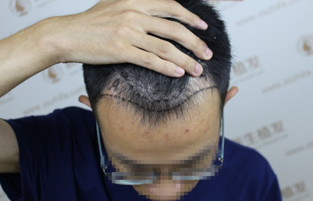 拿南京新生植发来拯救我的发际线，感谢各位医生