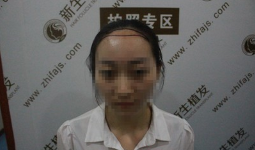 从“光辉”到“照辉”，我在广州新生植发的蜕变