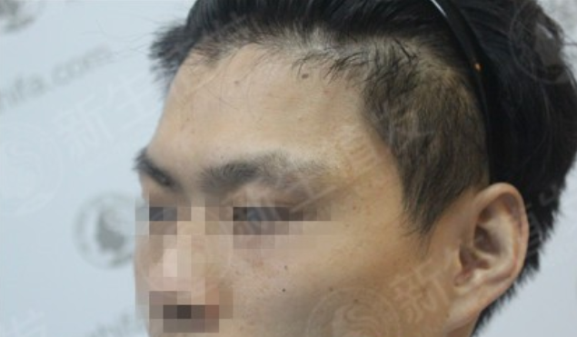 广州新生植发医院植发2000单位，改变自己就要从现在开始