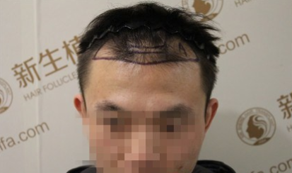 杭州新生植发医院为你打开另外一扇窗“自信”