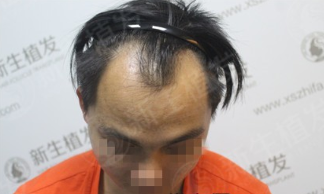 自古逢秋悲寂寥，脱发来广州新生专家为你专业看诊 