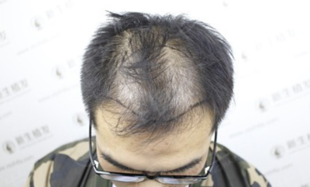 在广州新生植发，摆脱脱发烦恼，颜值上升很轻松！