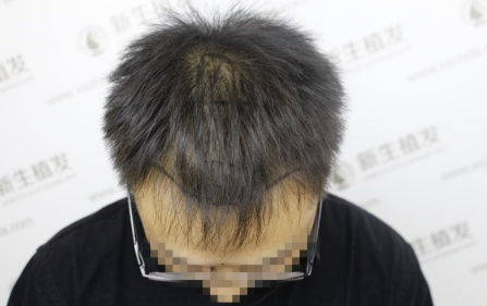 感谢南京新生植发，彻底帮我解决了脱发烦恼！