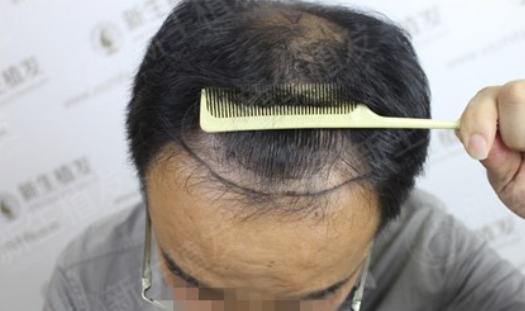 广州新生植发4500毛囊单位，重塑形象小意思！