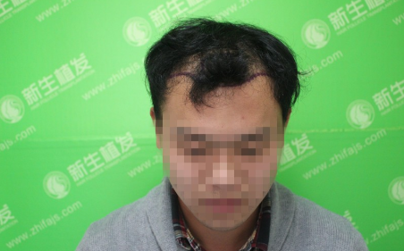 南京新生植发前前后后，终于知道什么是天壤之别