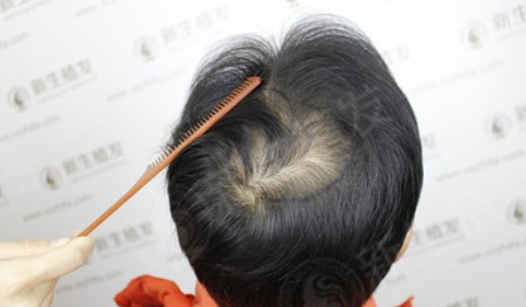 在广州新生植发3200毛囊单位，结果令人难以置信