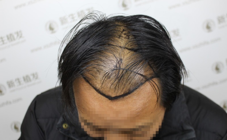 在南京新生植发后 我终于告别了“老秃”这个称号