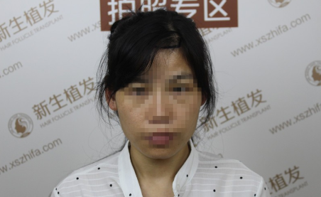 在南京新生植发后，终于告别了我头上的疤 心中的刺！