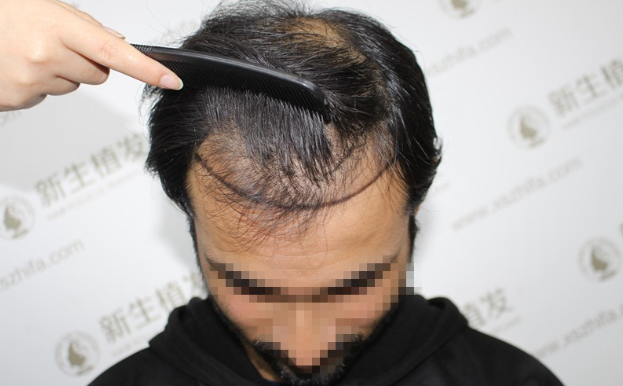 是南京新生植发，让我彻彻底底爱上了中国！