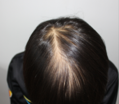 新发现女性加密2500单位，植发后零距离呈现