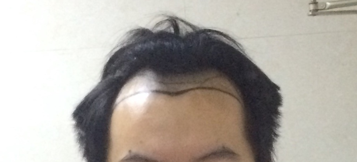 在深圳大麦微针植发2500单位后，期待额角头发能茁壮成长