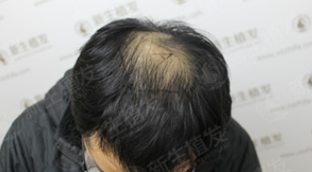 广州新生植发3000单位，彻底丢掉“脱发”的标签！