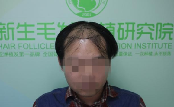 植发3300单位后，南京新生植发让他更加自信开朗