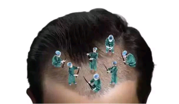 头发移植手术有危险吗