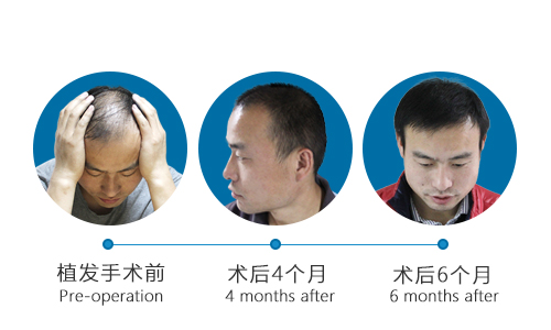 头发移植过程的详细情况有什么