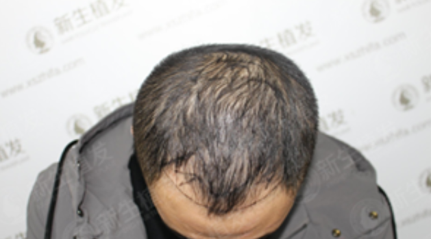 广州新生植发3500单位，形象彻底逆转！