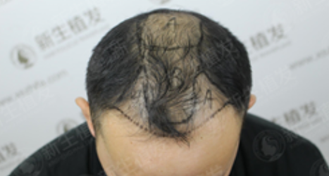 广州新生植发4500毛囊单位，让秀发如树叶般浓密