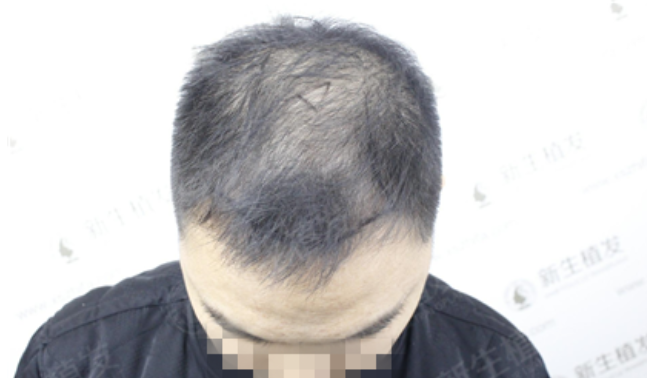 广州新生植发3500单位，6个月重返颜值巅峰！