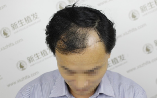 南京植发前前后后，就跟俩人一样，分享我的经历