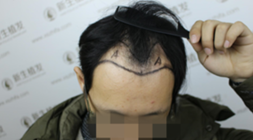 广州新生植发2500毛囊单位，让你的脱发失而复得