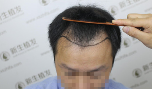 广州新生植发3200毛囊单位，4个月后“大秃”变“大帅”