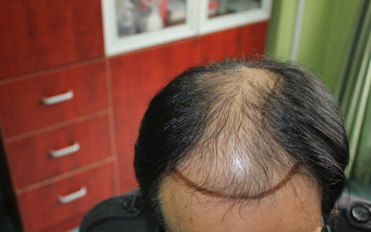 南京新生植发，让他从此告别“地中海”