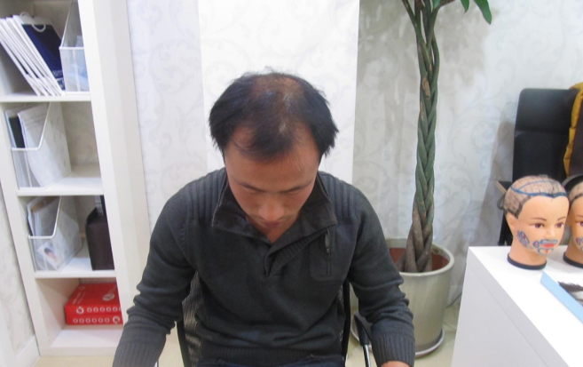 分享北京7个月植发效果，5级脱发4000单位