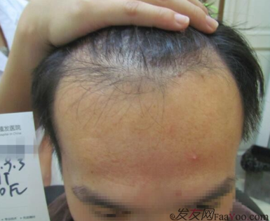 在武汉碧莲盛植发六个月，这效果是什么水平