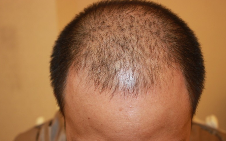 我的头等大事在成都大麦微针了结了，FUE+PTT 2800单位案例