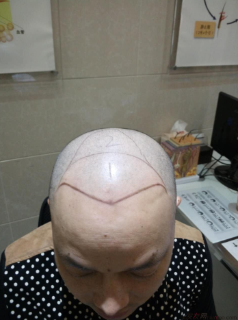 长沙大麦微针3311个单位，分享头发成长记