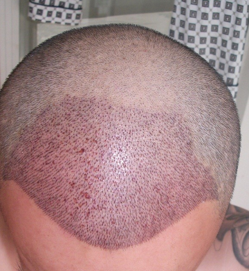 在上海植信植发归来，分享一年来的变化