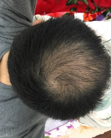 杭州大麦微针pse+fue=3884，新年一切从头开始！