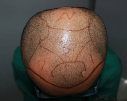 植发案例：感谢成都大麦微针植发王主任，咱是卷发咱怕谁