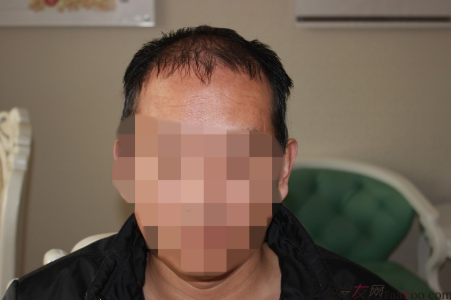 二次修复手术后7个月-感谢大麦微针成都分院的医生