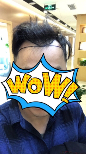 上海大麦微针M额角植发PSE1900单位，加油我会变帅的