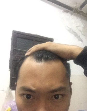 M角前额植发，选择大麦微针终究是选择对了