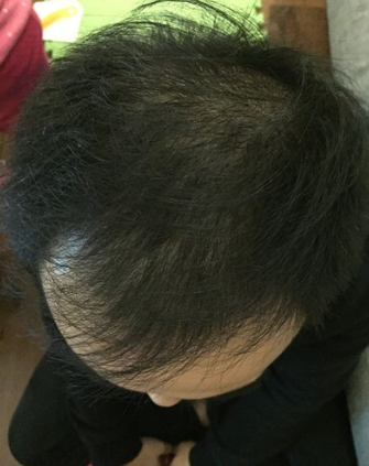 长沙大麦微针植发3510单位，一步步变帅的过程