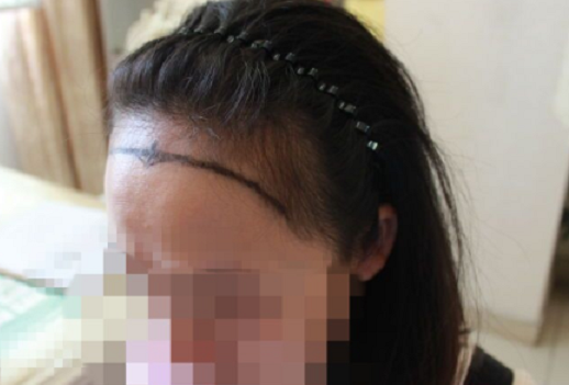 多年梦想终于实现发际线调整，成都大麦微针2900单位种植 