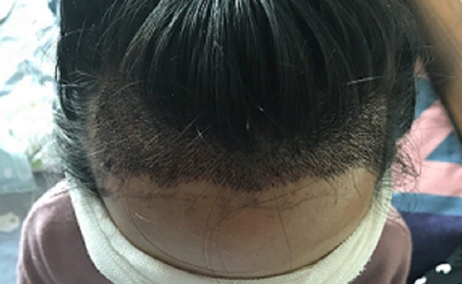 拜拜齐刘海，北京大麦微针女生发际线调整实录