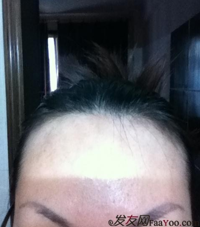 成都大麦微针王主任给我种了发际线和眉毛，我很满意