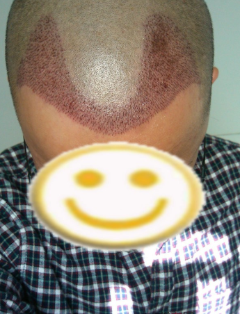 上海植信植发2100单位，分享一下我的植发记录我很满意