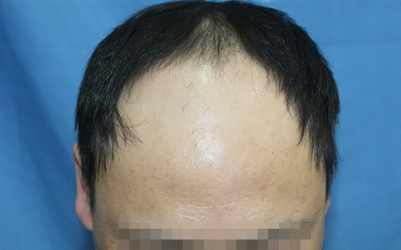 北京植发拯救我“宝塔式”脱发，从今以后只会越来越自信