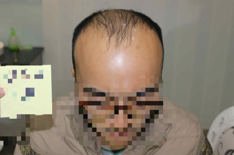 杭州大麦微针4000单位T+E，与发友一起成长