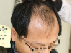 杭州大麦微针3200单位，看自己头发逐渐变化很开心