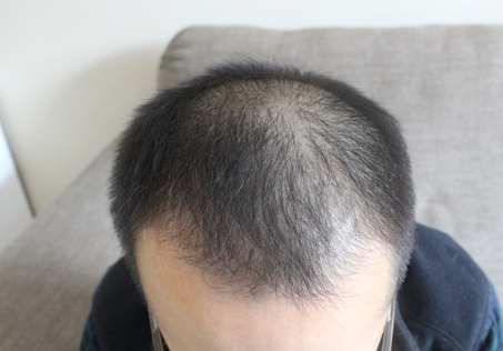 感谢力哥我选择了去植发，植发前后七个月变化