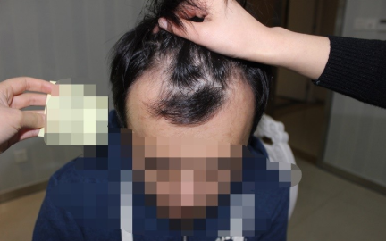 人生刚起步就遇到脱发问题，遇到大麦微针是我的幸运